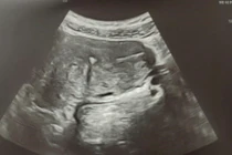 Tháo vòng cắm sâu vào cơ tử cung không cần mổ