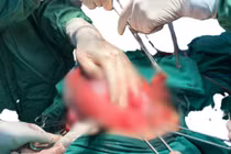 Cứu sống hai mẹ con sản phụ thai 34 tuần vỡ ruột thừa nguy kịch