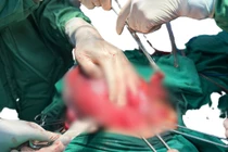 Cứu sống hai mẹ con sản phụ thai 34 tuần vỡ ruột thừa nguy kịch