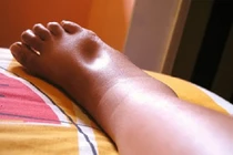 Phù chân do bệnh mạch máu?