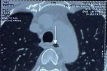 Ca cấp cứu nghẹt thở, dị vật sắc nhọn xuyên thực quản, sát động mạch chủ