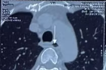 Ca cấp cứu nghẹt thở, dị vật sắc nhọn xuyên thực quản, sát động mạch chủ