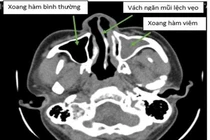 Đau đầu, nghẹt thở... do vẹo vách ngăn mũi