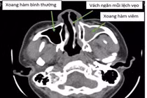 Đau đầu, nghẹt thở... do vẹo vách ngăn mũi
