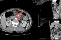 Tăm tre đâm vào mạch máu tạo giả phình mạch nguy cơ vỡ mạch đe dọa tính mạng