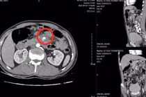 Tăm tre đâm vào mạch máu tạo giả phình mạch nguy cơ vỡ mạch đe dọa tính mạng
