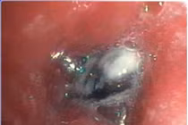 Ho dai dẳng 1 năm không ngờ thủ phạm là hạt trái cây trong phế quản