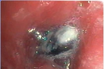 Ho dai dẳng 1 năm không ngờ thủ phạm là hạt trái cây trong phế quản