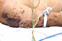 Tưởng nhiễm liên cầu khuẩn lợn không ngờ não mô cầu nguy kịch