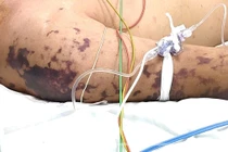 Tưởng nhiễm liên cầu khuẩn lợn không ngờ não mô cầu nguy kịch