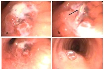 Ho sốt, viêm phổi kéo dài nhiều tháng không ngờ do dị vật phế quản