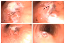Ho sốt, viêm phổi kéo dài nhiều tháng không ngờ do dị vật phế quản