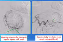 Đi ngoài phân đen bệnh nhân ung thư dạ dày sốc mất máu, suy đa cơ quan