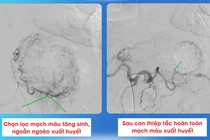 Đi ngoài phân đen bệnh nhân ung thư dạ dày sốc mất máu, suy đa cơ quan