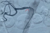 Đặt stent cứu cụ bà 85 tuổi mắc tăng huyết áp kháng trị uống thuốc không hạ