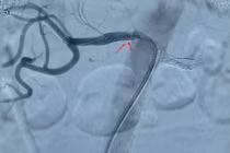 Đặt stent cứu cụ bà 85 tuổi mắc tăng huyết áp kháng trị uống thuốc không hạ