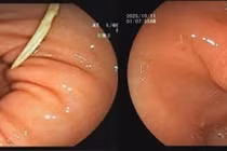 Xương gà mắc trong dạ dày 4 ngày gây loét nguy hiểm