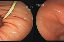 Xương gà mắc trong dạ dày 4 ngày gây loét nguy hiểm