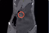 Chàng trai 17 tuổi thủng ổ loét môn vị tá tràng nguy kịch vì thức khuya