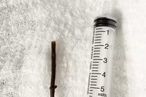 Uống thuốc lá tự sắc, người đàn ông bị thủng dạ dày do mảnh cây