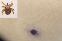 Sốt mò, bệnh truyền nhiễm, ấu trùng mò, suy tim, suy thận, suy hô hấp, sốt