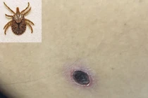 Sốt mò, bệnh truyền nhiễm, ấu trùng mò, suy tim, suy thận, suy hô hấp, sốt