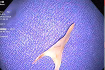 Ăn tất niên, người phụ nữ 76 tuổi hóc xương thực quản