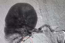 Cấp cứu giữa đêm giành giật sự sống cho bệnh nhân vỡ thận 