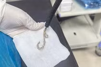 Bệnh nhi 2 tuổi nuốt lắc bạc vào dạ dày