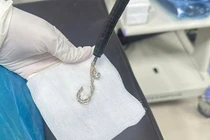 Bệnh nhi 2 tuổi nuốt lắc bạc vào dạ dày