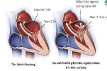 Không triệu chứng, người 40 năm khỏe mạnh phát hiện bệnh tim nguy hiểm