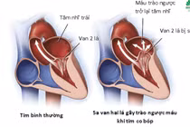 Không triệu chứng, người 40 năm khỏe mạnh phát hiện bệnh tim nguy hiểm