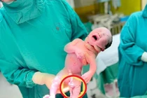 Hiếm gặp trẻ có dây rốn dài 1m, xoắn vặn nhiều vòng