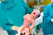 Hiếm gặp trẻ có dây rốn dài 1m, xoắn vặn nhiều vòng