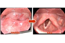 Một cơn đau họng cấp, người phụ nữ phù nề thanh quản đe dọa tính mạng