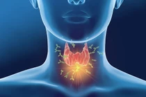 Cảnh giác các loại viêm nhiễm tuyến giáp ảnh hưởng sức khỏe