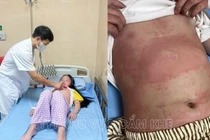 Xuất hiện nhiều trẻ mắc bệnh ban nhiễm khuẩn