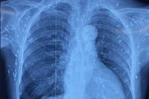 Sán dây lợn làm tổ trong não, phổi và dưới da người phụ nữ 77 tuổi