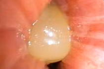 Ăn ngô bị sặc, người phụ nữ 60 tuổi suy hô hấp nguy kịch