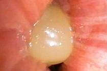 Ăn ngô bị sặc, người phụ nữ 60 tuổi suy hô hấp nguy kịch