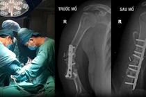 Lấy xương chậu ghép vào cánh tay điều trị khớp giả 
