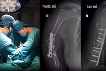 Lấy xương chậu ghép vào cánh tay điều trị khớp giả 