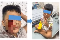 Bé 5 tuổi bị chó cắn hàng chục vết thương sâu ở mặt