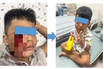 Bé 5 tuổi bị chó cắn hàng chục vết thương sâu ở mặt