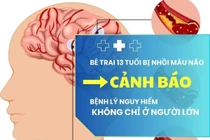 Đang khỏe mạnh, bé trai 13 tuổi đột ngột nhồi máu não