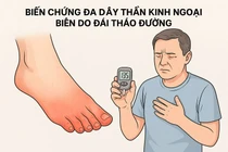 Nguy cơ cắt cụt chi do biến chứng đa dây thần kinh ngoại biên do tiểu đường