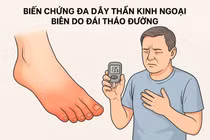Nguy cơ cắt cụt chi do biến chứng đa dây thần kinh ngoại biên do tiểu đường