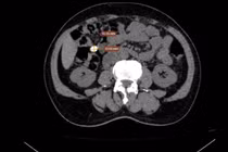 Nhiều năm uống thuốc sỏi thận không ngờ là nốt vôi hóa