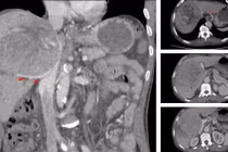 Hành trình giành sự sống cho người bệnh ung thư gan 'tiên lượng 9 tháng'