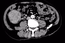 Mệt mỏi, đi ngoài phân đen không ngờ ung thư đại tràng di căn gan